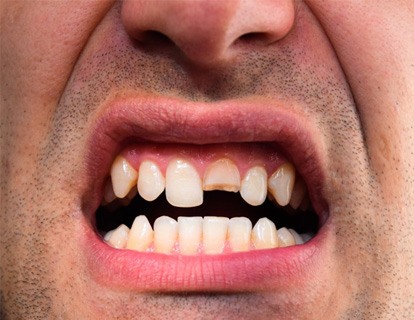 Man showing his broken tooth