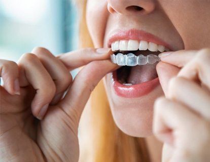 Woman inserting a clear aligner