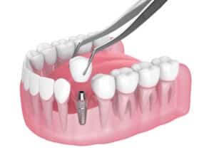 Close-up of dental implant, dental implants healing Springfield, MA